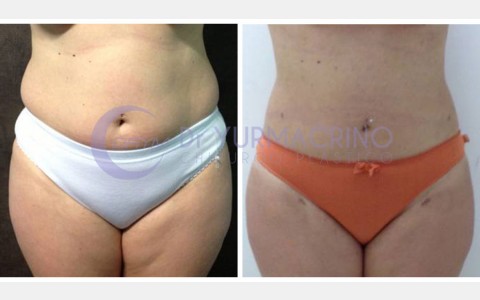 Abdomen/Hips Liposculpture – Case 10/A