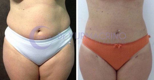 Abdomen/Hips Liposculpture – Case 10/A