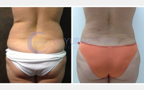 Abdomen/Hips Liposculpture – Case 10/B