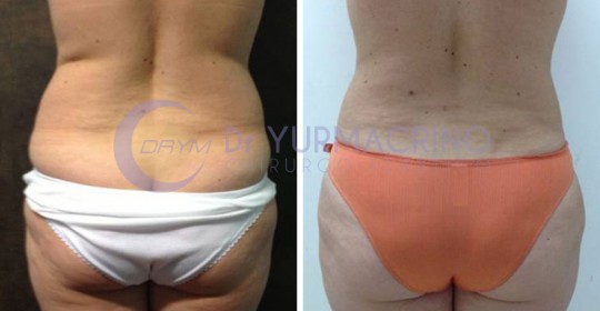 Abdomen/Hips Liposculpture – Case 10/B