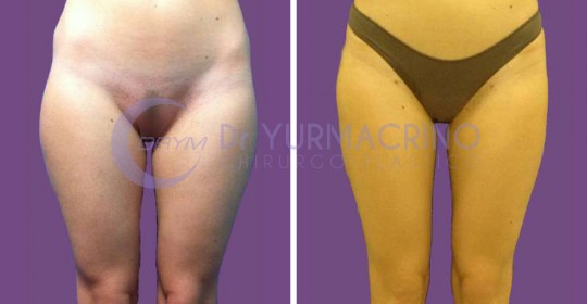 Liposcultura Gambe/Glutei – Caso 1/A