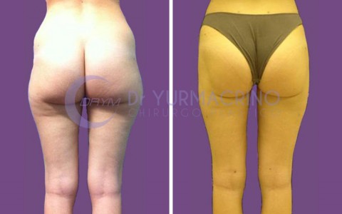 Liposcultura Gambe/Glutei – Caso 1/B