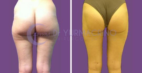 Liposcultura Gambe/Glutei – Caso 1/B