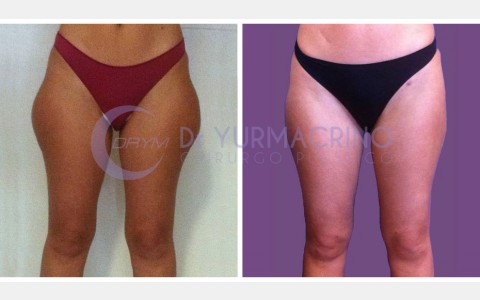 Liposcultura Gambe/Glutei – Caso 2/A