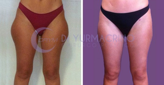 Liposcultura Gambe/Glutei – Caso 2/A