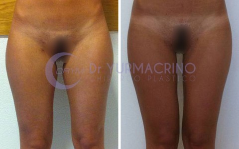 Liposcultura Gambe/Glutei – Caso 3/A