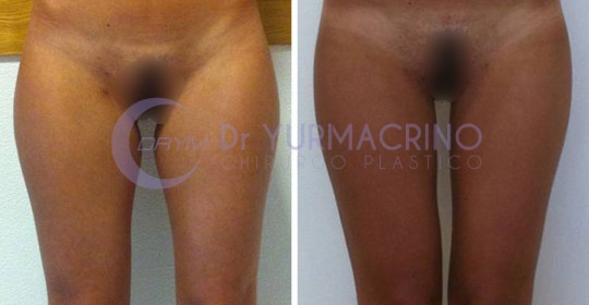 Liposcultura Gambe/Glutei – Caso 3/A