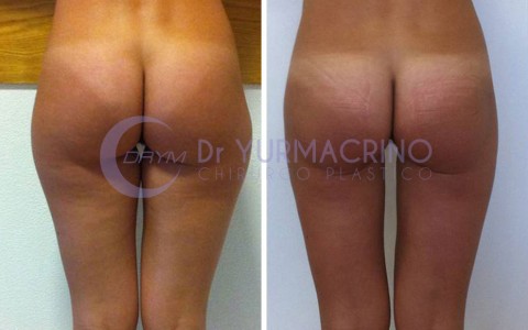 Liposcultura Gambe/Glutei – Caso 3/B