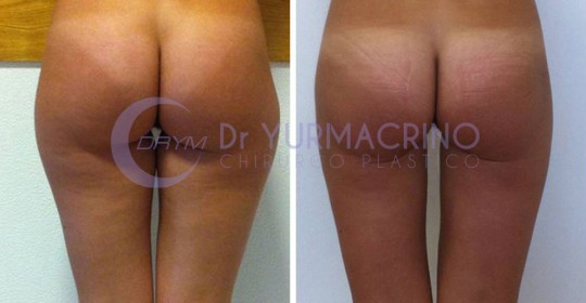 Liposcultura Gambe/Glutei – Caso 3/B