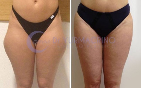 Liposcultura Gambe/Glutei – Caso 4/A