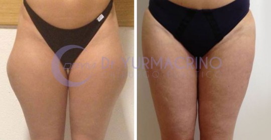 Liposcultura Gambe/Glutei – Caso 4/A