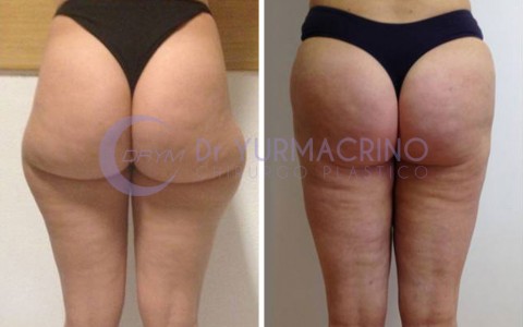 Liposcultura Gambe/Glutei – Caso 4/B