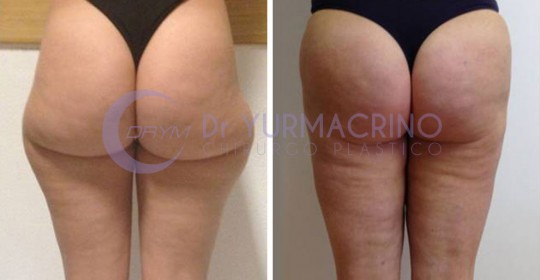 Liposcultura Gambe/Glutei – Caso 4/B