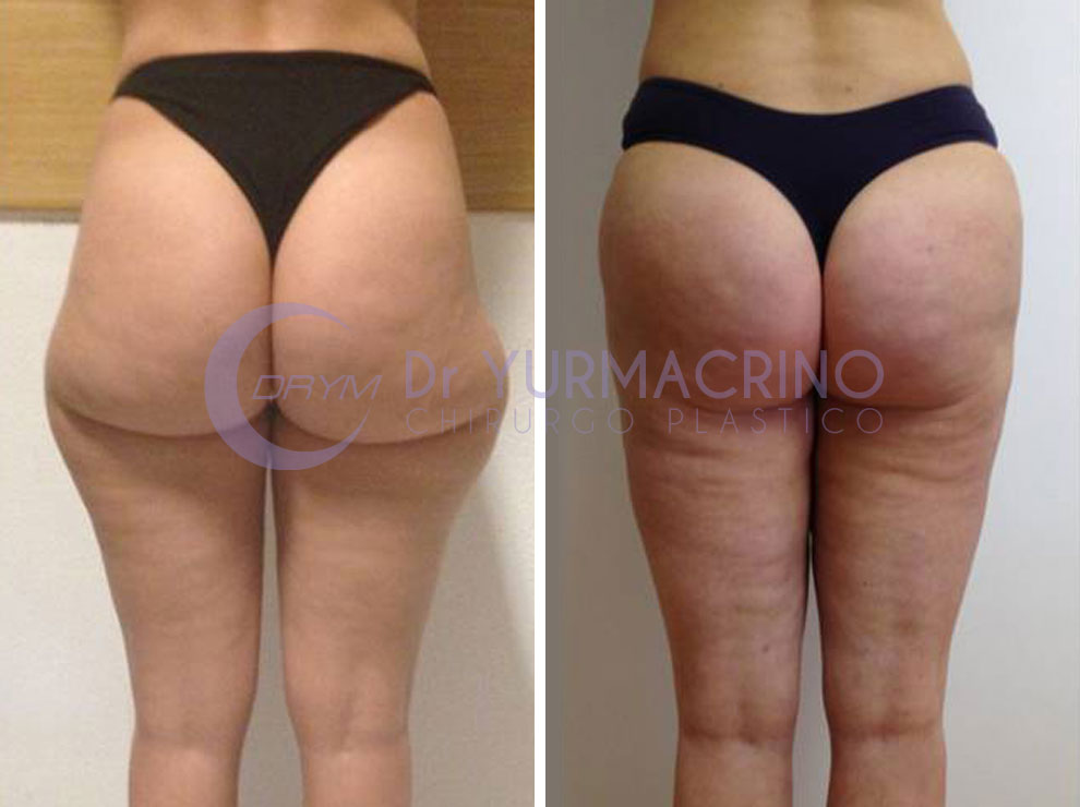 primadopo_lipo_gambe_glutei_004b