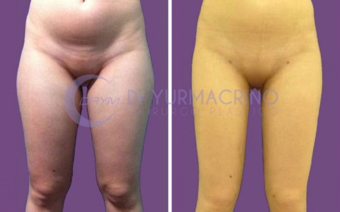 Liposcultura Gambe/Glutei – Caso 5/A