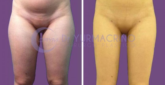 Liposcultura Gambe/Glutei – Caso 5/A