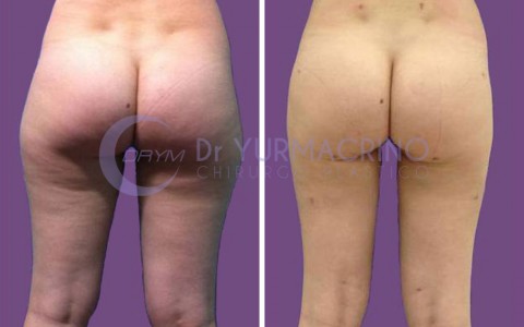 Liposcultura Gambe/Glutei – Caso 5/B