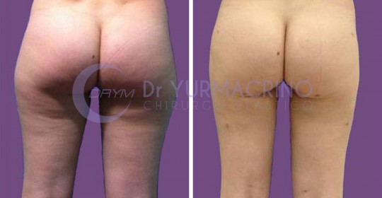 Liposcultura Gambe/Glutei – Caso 5/B