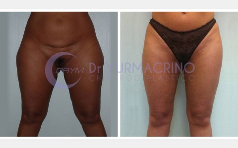 Liposcultura Gambe/Glutei – Caso 6/A