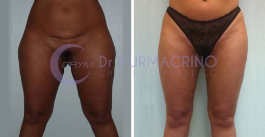 Liposcultura Gambe/Glutei – Caso 6/A