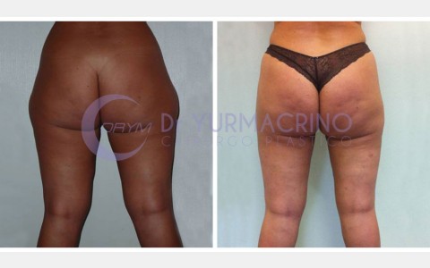 Liposcultura Gambe/Glutei – Caso 6/B