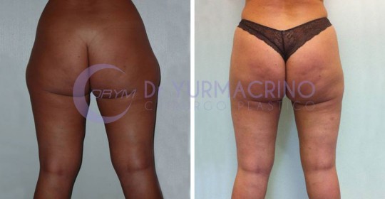 Liposcultura Gambe/Glutei – Caso 6/B