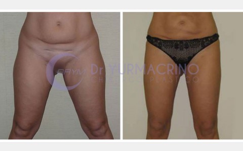 Liposcultura Gambe/Glutei – Caso 7/A