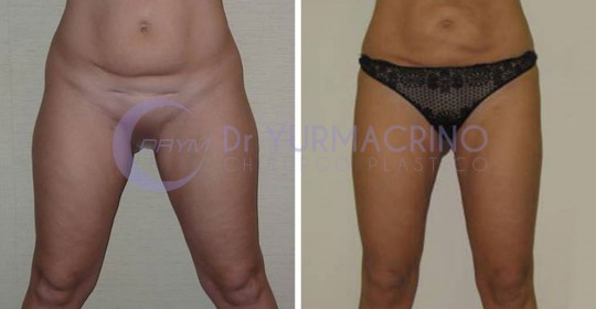 Liposcultura Gambe/Glutei – Caso 7/A