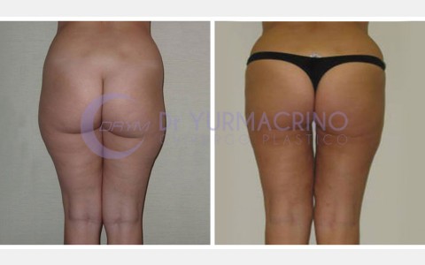 Liposcultura Gambe/Glutei – Caso 7/B