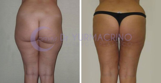 Liposcultura Gambe/Glutei – Caso 7/B