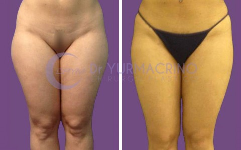 Liposcultura Gambe/Glutei – Caso 8/A