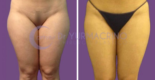 Liposcultura Gambe/Glutei – Caso 8/A