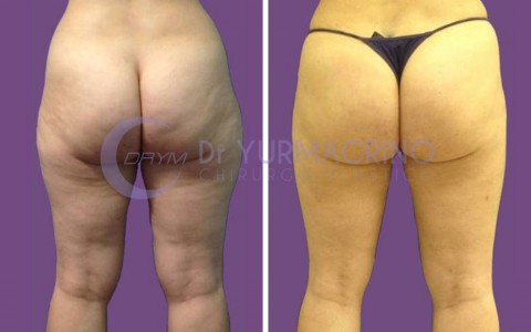 Liposcultura Gambe/Glutei – Caso 8/B