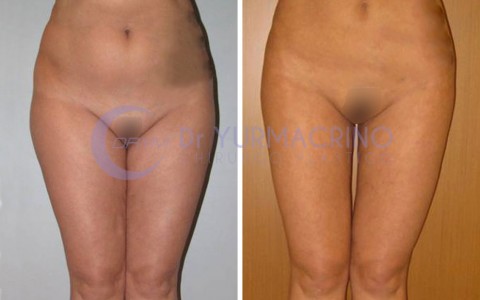 Liposcultura Gambe/Glutei – Caso 9/A