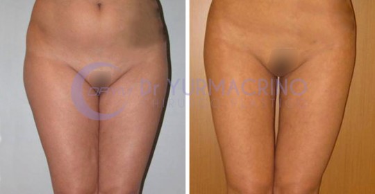 Liposcultura Gambe/Glutei – Caso 9/A