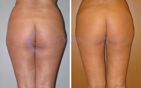 Liposcultura Gambe/Glutei – Caso 9/B