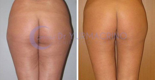 Liposcultura Gambe/Glutei – Caso 9/B