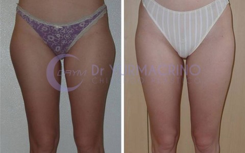 Liposcultura Gambe/Glutei – Caso 10/A