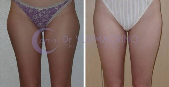 Liposcultura Gambe/Glutei – Caso 10/A