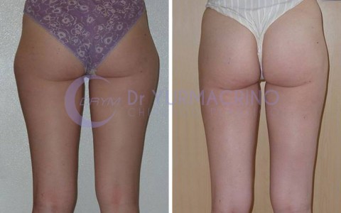 Liposcultura Gambe/Glutei – Caso 10/B