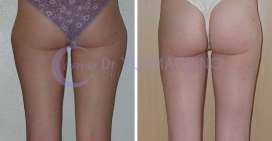 Liposcultura Gambe/Glutei – Caso 10/B