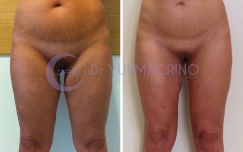 Liposcultura Gambe/Glutei – Caso 11/A