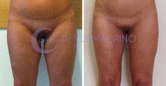 Liposcultura Gambe/Glutei – Caso 11/A