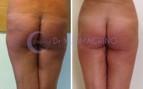 Liposcultura Gambe/Glutei – Caso 11/B