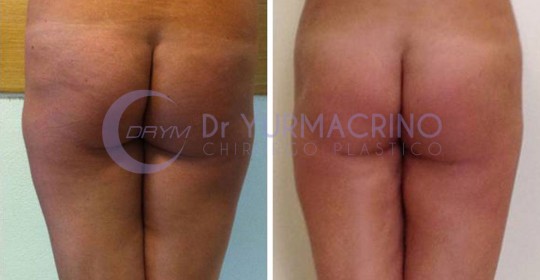 Liposcultura Gambe/Glutei – Caso 11/B