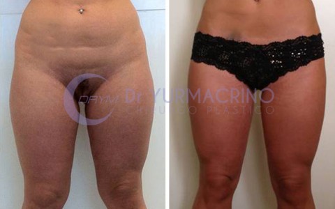 Liposcultura Gambe/Glutei – Caso 12/A