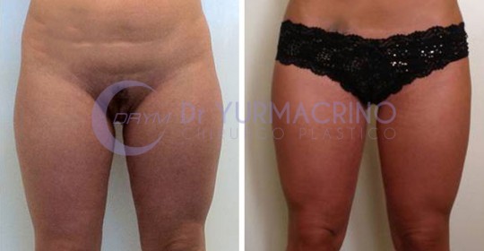 Liposcultura Gambe/Glutei – Caso 12/A