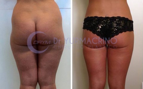 Liposcultura Gambe/Glutei – Caso 12/B