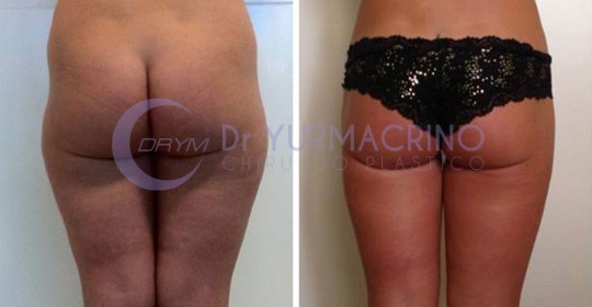 Liposcultura Gambe/Glutei – Caso 12/B