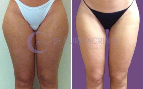 Liposcultura Gambe/Glutei – Caso 13/A